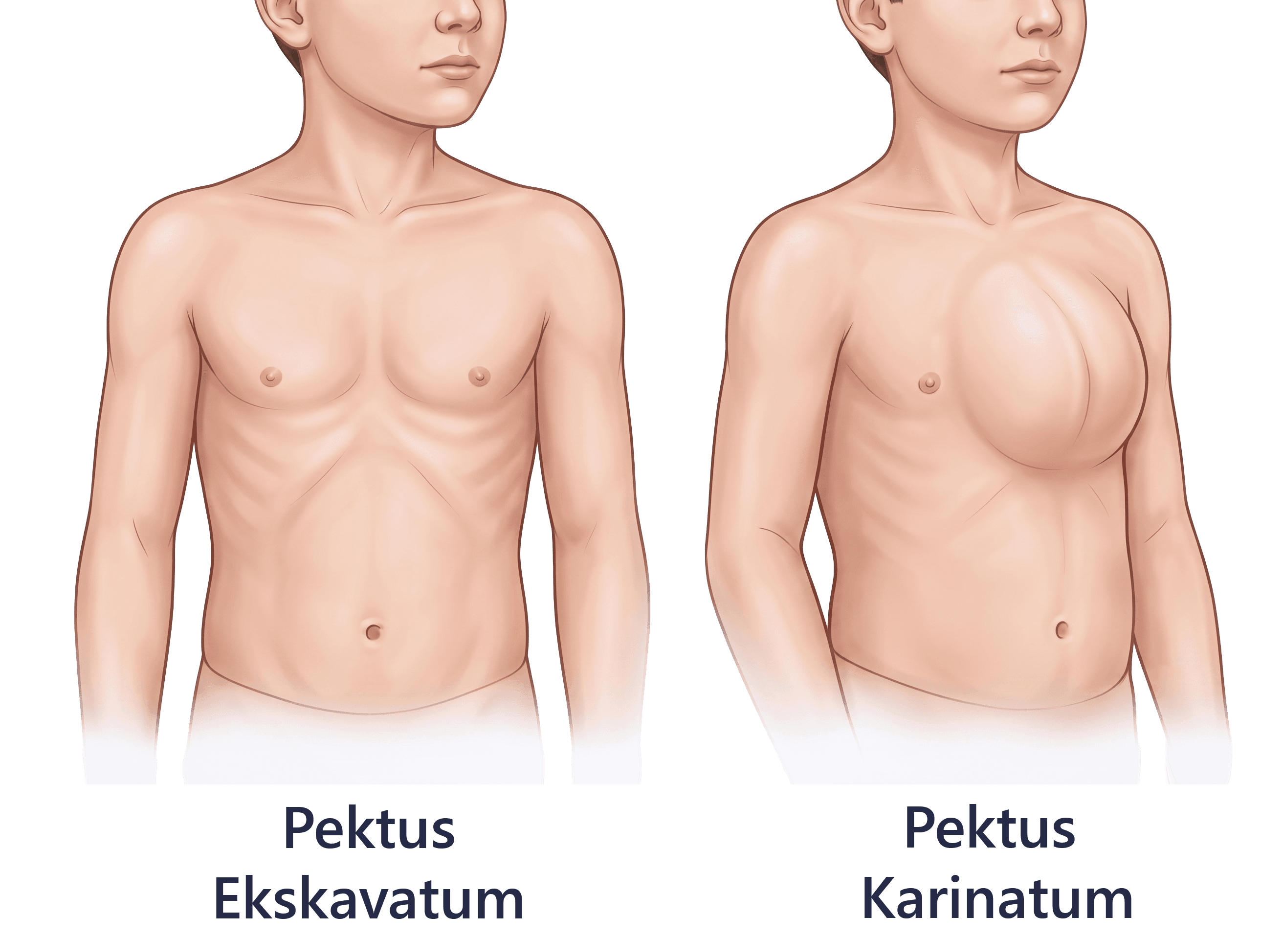 Çocuklarda Göğüs Duvarı Hastalıkları ve Deformiteleri