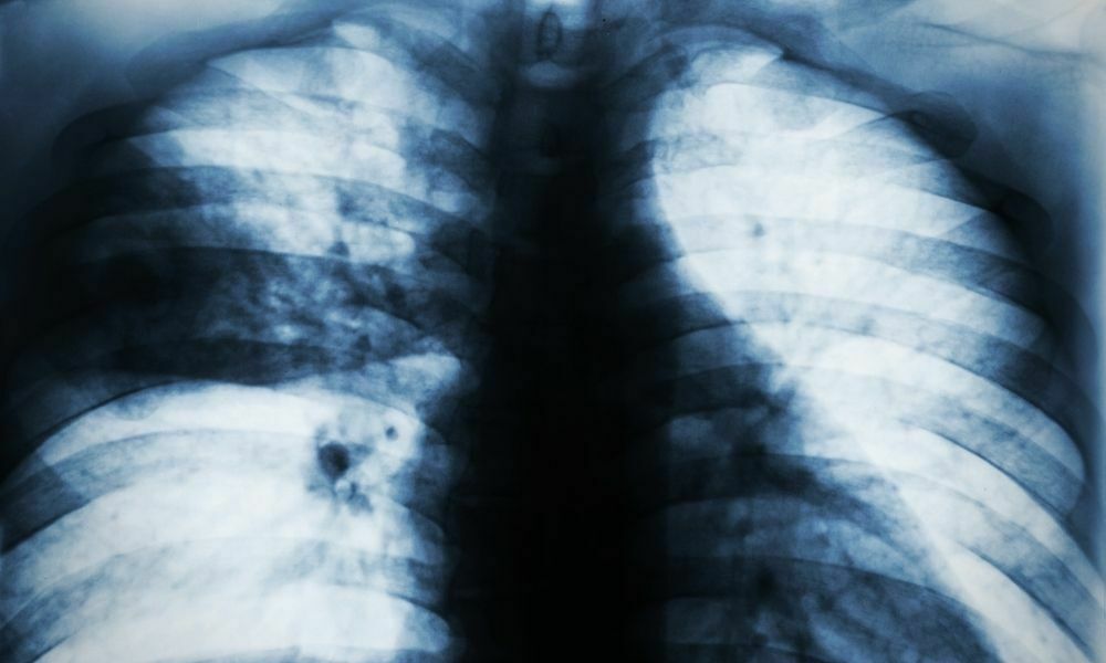 Congenital Lung Diseases