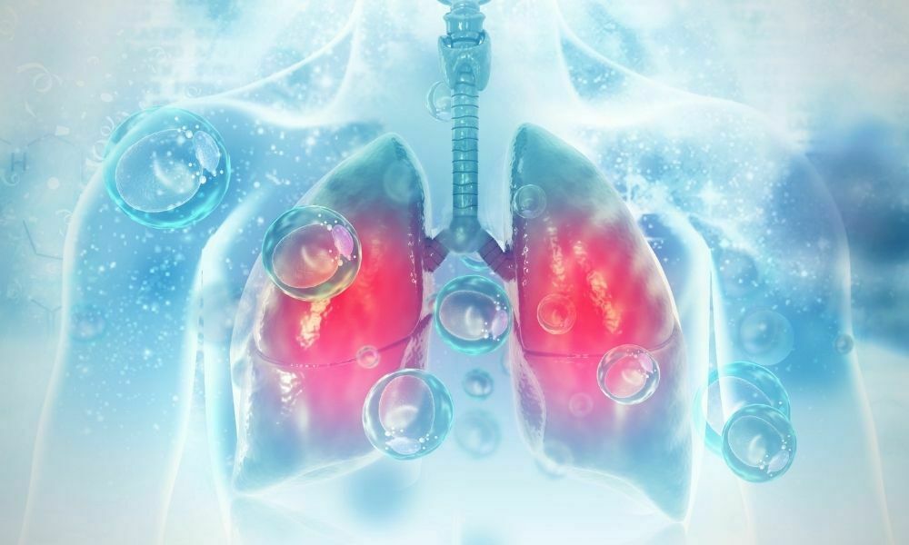 akciğer kanserinde evreleme
