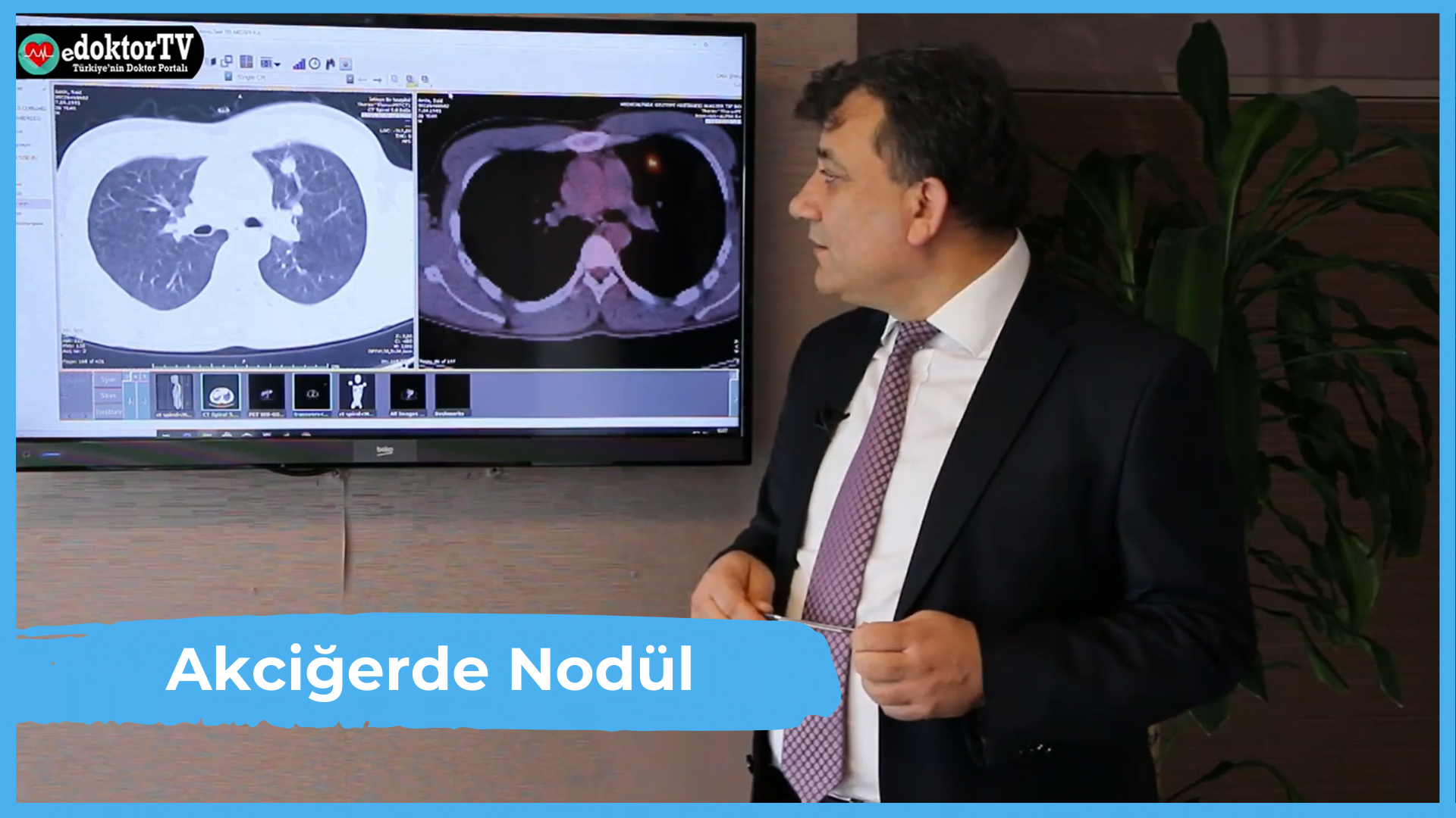 Akciğerde Nodül