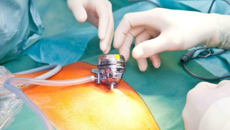 minimal invaziv göğüs cerrahisi