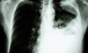 lung metastasis