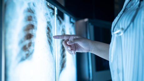 Diafragma Hastalıklarının Cerrahi Tedavisi