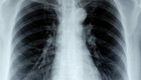 Torasik Çıkış Sendromu Tanısı