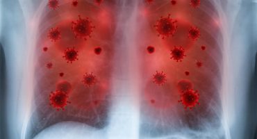 Bronş Tümörleri Nedir