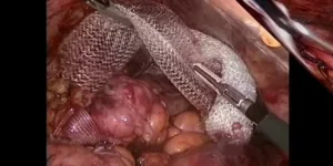 Metastazektomi Metastazektomi